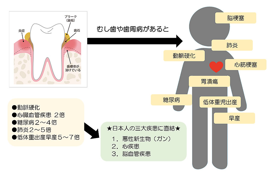 お口の中の健康と全身疾患の関係